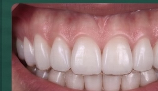 After: Clear Aligner Journey, 9 Months