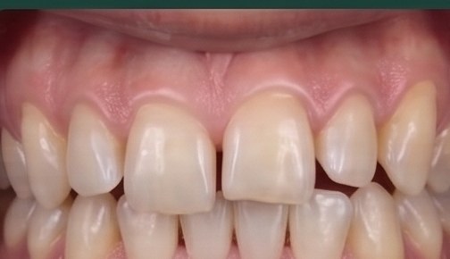 Before: Clear Aligner Journey, 9 Months