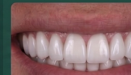 After: Porcelain Veneers, 6 Units